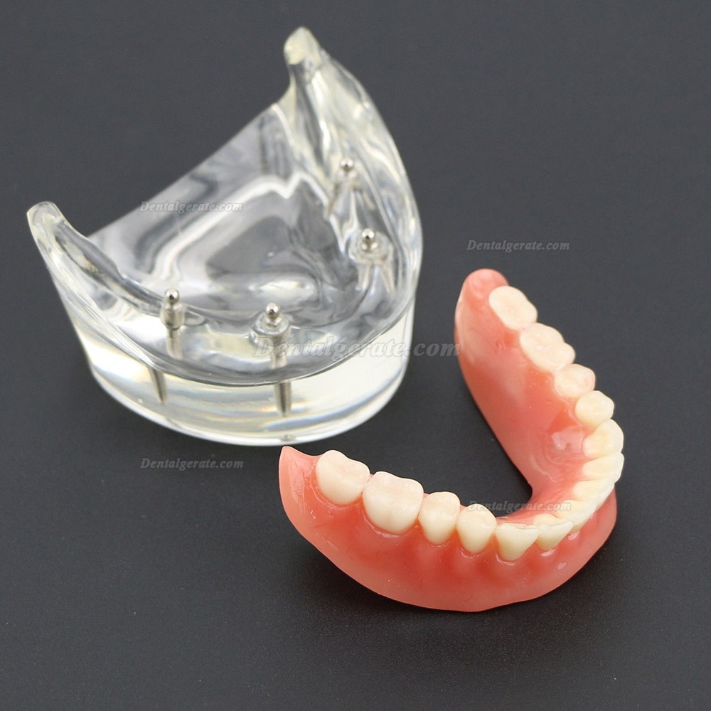 Dental Lower Z&auml;hne Demo-Studienmodell 6002 02 Overdenture Unten 4 Implantate